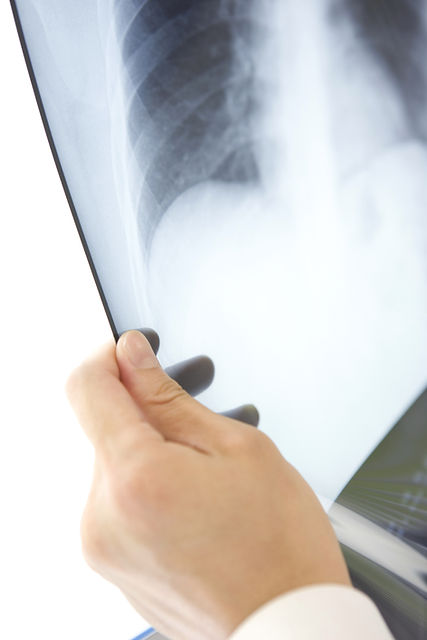 Hand holding chest x-ray film up against light